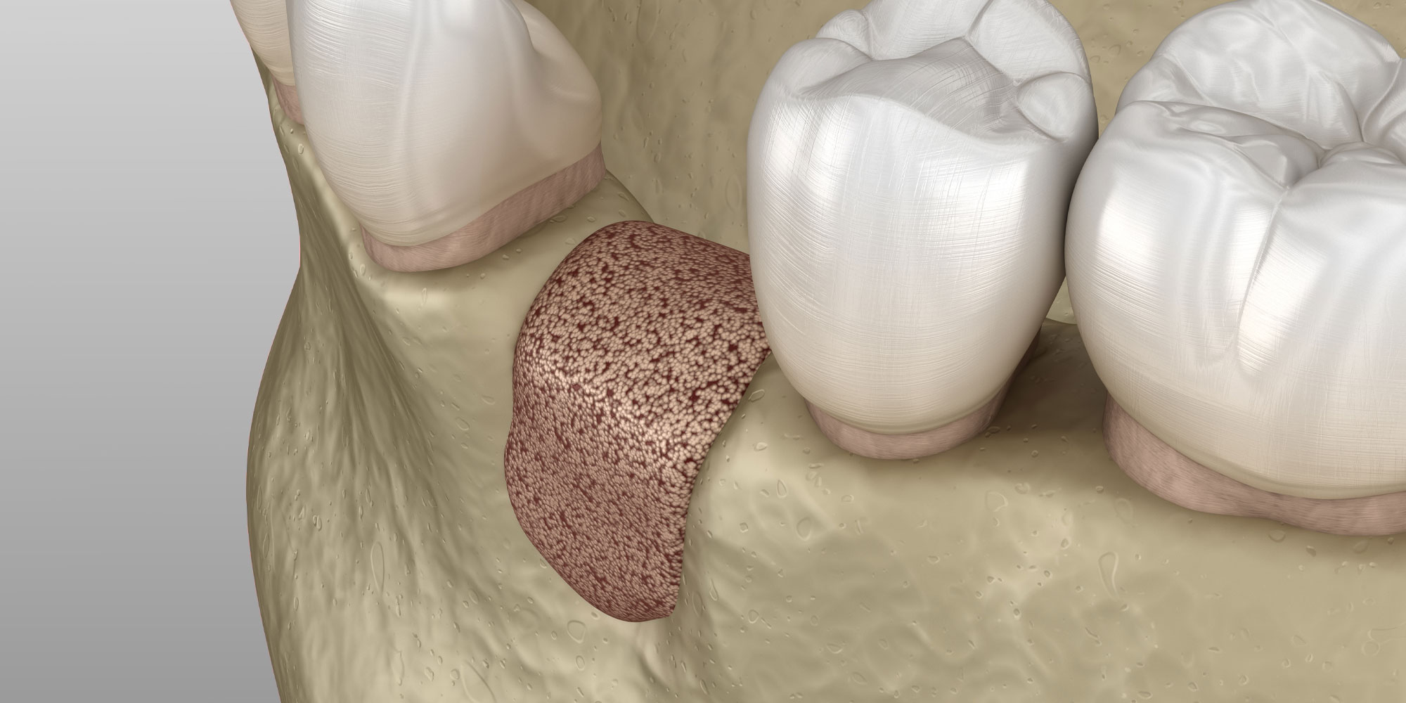 damanged-tooth-graphic