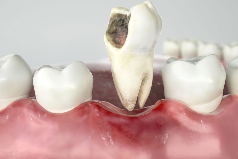 damanged-tooth-graphic