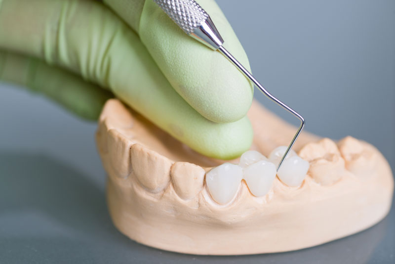 dental-bridge-model
