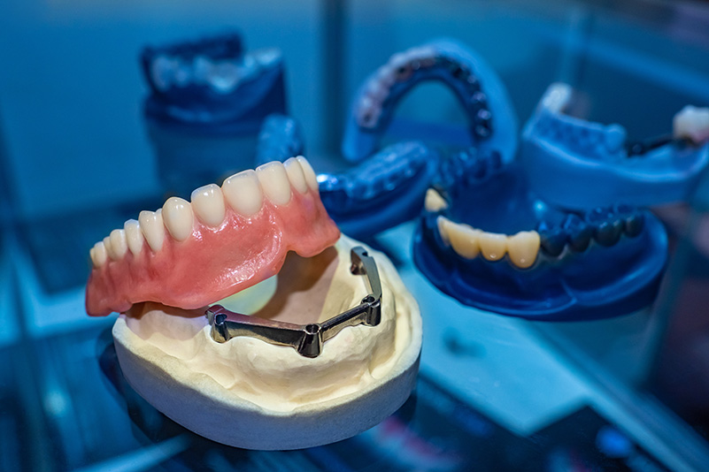 Implant supported denture model