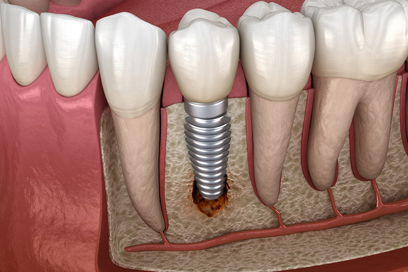 peri-implantitis model
