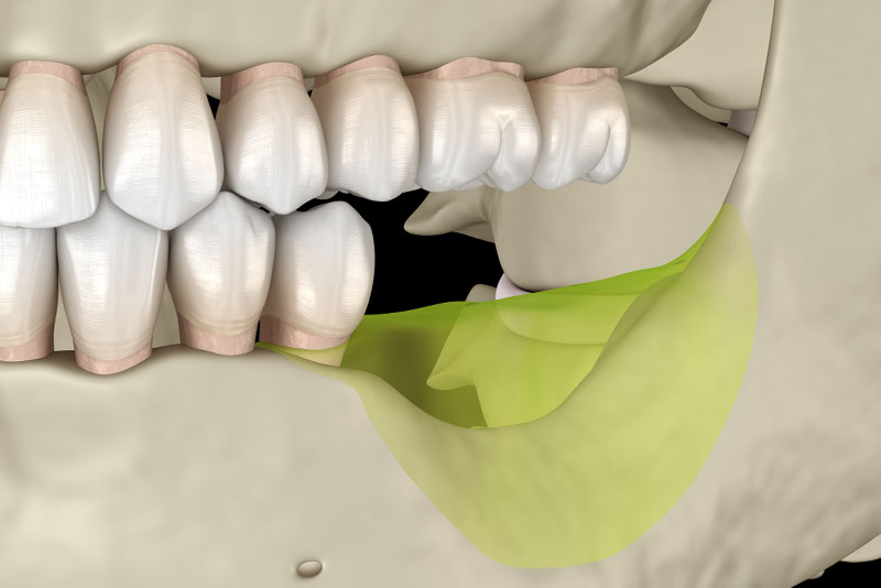 ridge-augmentation-graphic