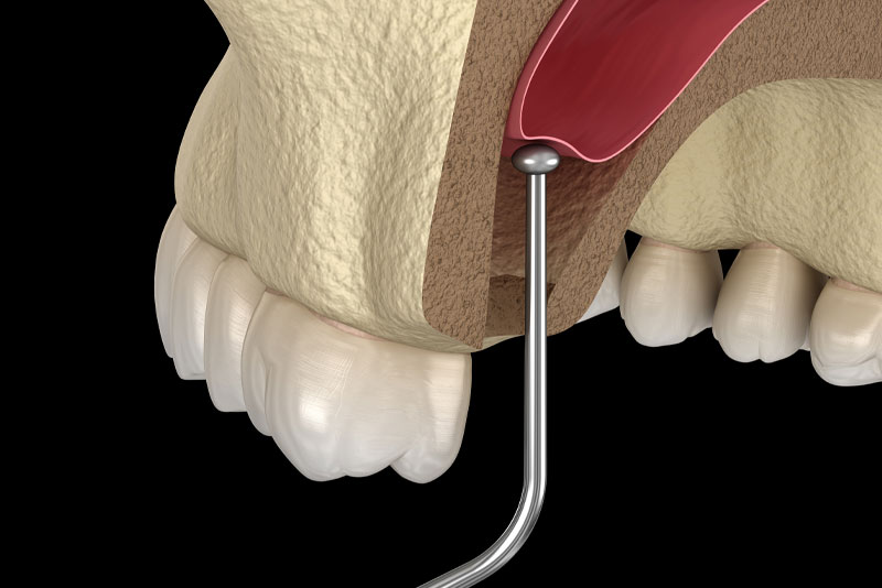sinus-lift-graphic