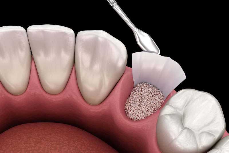 socket-preservation-graphic