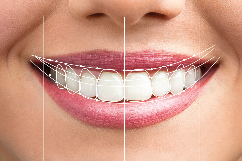 dental SMile design