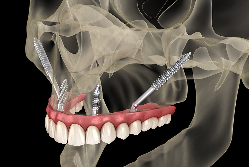 Maxillary prosthesis supported by zygomatic implants